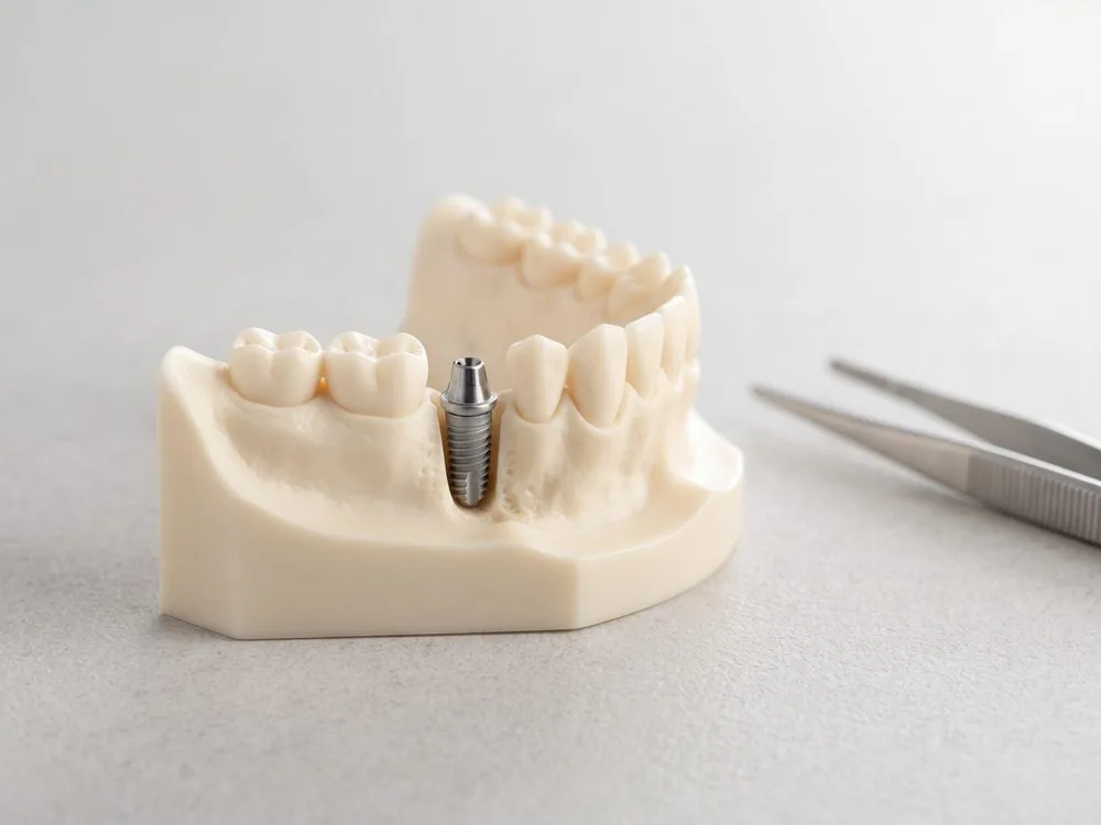 Kiefermodell mit einem einzelnen Implantat